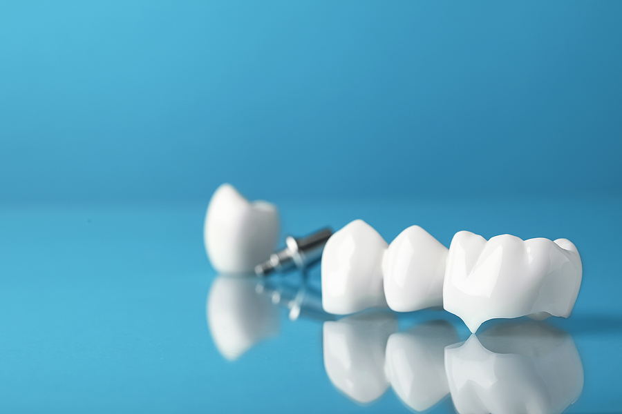 The Ultimate Guide to Dental Crowns: Enhancing Your Smile and Oral Health