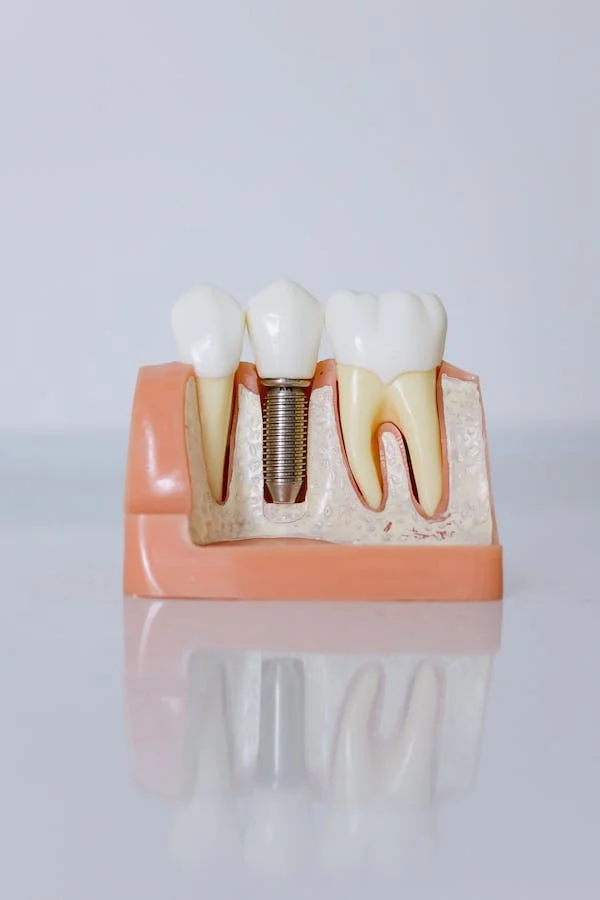 Are You Suitable for Dental Implants?